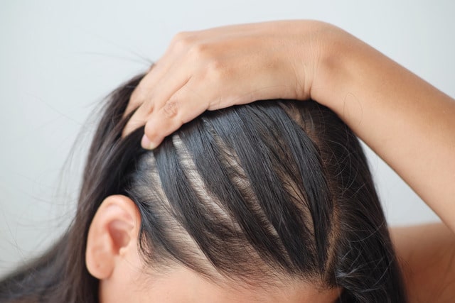 Common medications that are causing your hair to fall out
